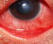 โรคเยื่อบุตาอักเสบหรือโรคตาแดง (Haemorrhagic Conjunctivitis)